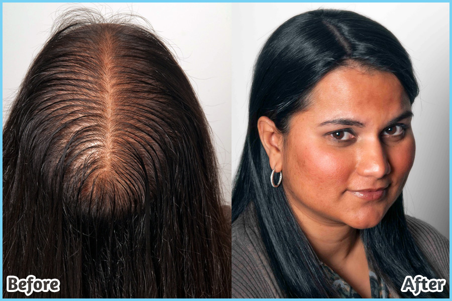 regrowing hairline female